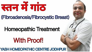 Breast Lump treatment । स्तन मे गाँठ का ईलाज ।fibroadenoma breast homeopathic treatment [upl. by Delisle]