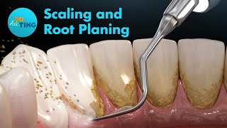 Dentistry Decoded Scaling and Root Planing [upl. by Nosretep407]