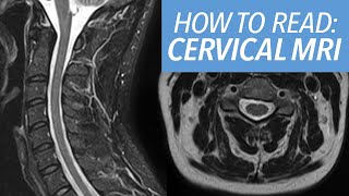 How to Read an MRI of the Cervical Spine Beginners Approach and Sequences Explained [upl. by Bilicki]