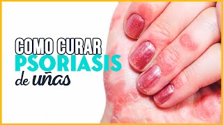 Como eliminar la PSORIASIS DE UÑAS  Trucos y mas [upl. by Ham]