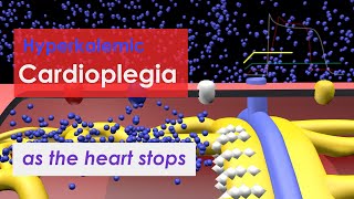 Hyperkalemic Cardioplegia [upl. by Windzer183]