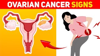 9 Warning Signs of Ovarian Cancer Every Woman Should Know [upl. by Aennaej]