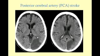 Stroke Syndromes older version with sound  CRASH Medical Review Series [upl. by Hadeehuat]