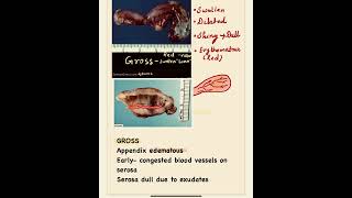 Acute appendicitis pathology✔️impt topic path practical [upl. by Lleryt344]