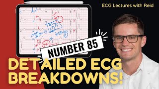 Improve your EKG Skills test yourself  ECG No 85 [upl. by Leunamnauj]