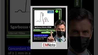 Sgarbossa Criteria of STEMI [upl. by Esineg426]