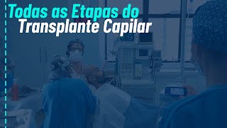 Etapas do transplante capilar  Transplante de cabelo do planejamento ao pósoperatório [upl. by Sura65]