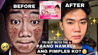 PAANO NAWALA ANG PIMPLES KO  SKIN CARE FOR MEN [upl. by Drarreg]