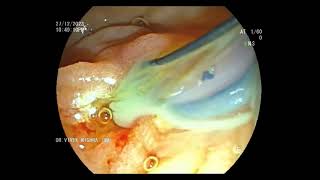 Severe Cholangitis  ERCP [upl. by Aramoix355]