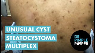 An Unusual Cyst Steatocystoma Multiplex [upl. by Adine]