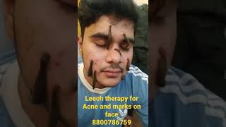 जुका Therapy Leech Therapy for Acne [upl. by Jarietta]