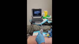 Pes Anserine bursitis injection under ultrasoundguidance [upl. by Aehs64]