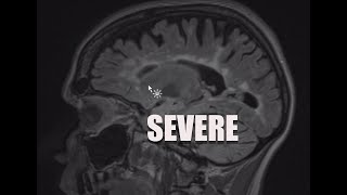 Understand Your Scan MS MRI and Brain Atrophy [upl. by Omari]