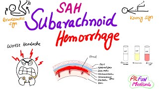 Subarachnoid Hemorrhageberry aneurysmSAHNeurosurgery [upl. by Ailido]