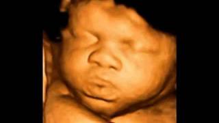 What is 4D ultrasound scan [upl. by Wavell]