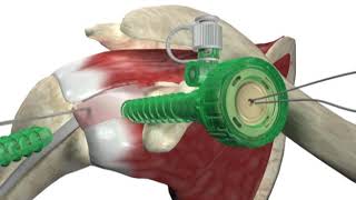 Biceptor Tenodesis System  Surgical Technique Walkthrough  SIMON MOYES [upl. by Anoel]