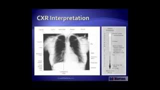 5 Steps to Chest Xray Interpretation [upl. by Lonna]