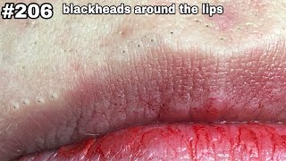 206  blackheads around the lips  BYoung Spa Quyet Hair 2 [upl. by Davidde87]