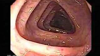 Endoscopia del Colon Colonoscopia [upl. by Lannie]