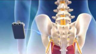 Overview of Sacral Nerve Stimulation for Urinary Control [upl. by Bick226]