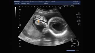 Ultrasound Video showing hydrocephalic fetus [upl. by Jones]