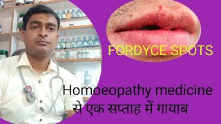 FORDYCE SPOTS cause symptoms and homoeopathic remedies [upl. by Eiddet]