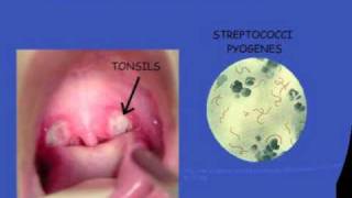 Streptococcal pharyngitis [upl. by Franklin351]