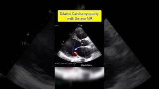 Dilated Cardiomyopathy with Severe MR cardiology heart cardionotes cardiologynotes [upl. by Ennahgem568]