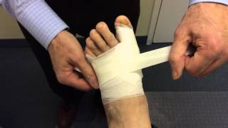 Redressing Following Minimally Invasive Bunion Surgery [upl. by Nnaesor910]