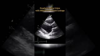 Prosthetic Mitral Valve echocardiogram echo Echocardiography For Beginners [upl. by Nueoht853]