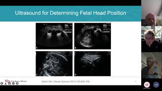 “Ces Delivery in the 2nd Stage Mgmt of the Impacted Fetal Head”  Dr John Williams III 202302 [upl. by Fulbright]