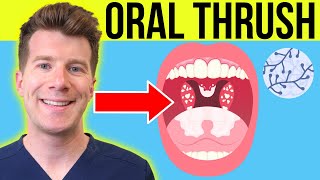 Doctor explains ORAL THRUSH Oral Candidiasis  Symptoms treatment amp prevention in adultsbabies [upl. by Roice193]