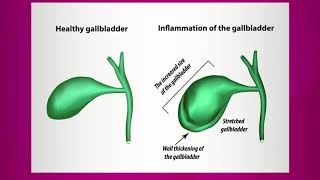 Pain Caused by Gallbladder Inflammation [upl. by Esilec]