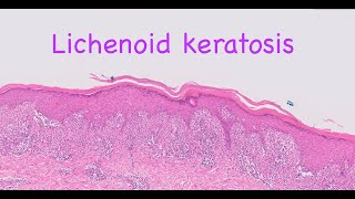 Lichenoid keratosis [upl. by Rudman]