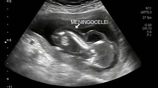 Ultrasound Video showing intrauterine death of fetus with encephalocele and meningocele [upl. by Simetra]