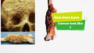 This is how a bone cancer looks like Osteosarcoma [upl. by Dennet]