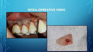 Gingival recession coverage by connective tissue graft Tooth 14 [upl. by Carvey]