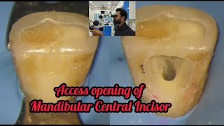 Access opening of Mandibular Central Incisor step by step demonstration rct for beginners rct [upl. by Clayton]