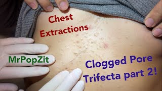 Clogged pores on the chest PART 2 Blackheads steatos and vellus hair cysts Part 1 link below [upl. by Cyn]