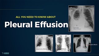 Pleural Effusion  Types Causes Evaluation amp Management All You Need To Know For Exam [upl. by Ahser]