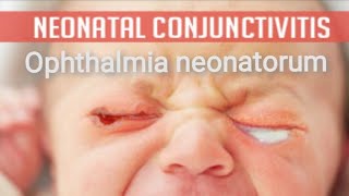 Conjunctiva  purulent conjunctivitis  Ophthalmia neonatorum Part 3 [upl. by Jr]