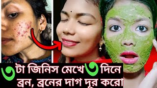 ব্রন ও ব্রনের দাগ দূর করার উপায়  100  কার্যকরী  Pimple  Darksopt Remove in Bangla [upl. by Eckart]