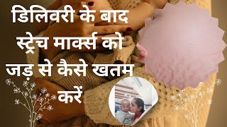 स्ट्रेच मार्क्स को कैसे हटायेंस्ट्रेच मार्क्स क्यों आते How to Remove Stretch Marks After Pregnancy [upl. by Ylatan]