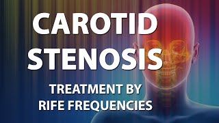 Carotid Stenosis Artery  RIFE Frequencies Treatment  Energy amp Quantum Medicine with Bioresonance [upl. by Analeh]