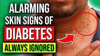 8 ALARMING Skin Signs Of Diabetes You Should NOT Ignore [upl. by Routh]