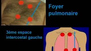 Foyer dauscultation cardiaque plus dexplication sur ce citehttpswwwfile4netfnM0 [upl. by Anawit4]