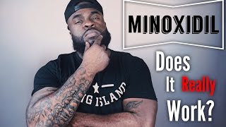 Does Minoxidil Really Work  Minoxidil Beard Growth [upl. by Ardnos190]