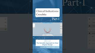 Clinical Indications Crossbite Part 1 [upl. by Kalila492]