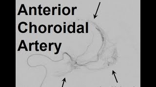 Anterior Choroidal Artery Angiogram [upl. by Kirsti]