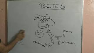 Ascites [upl. by Suk]